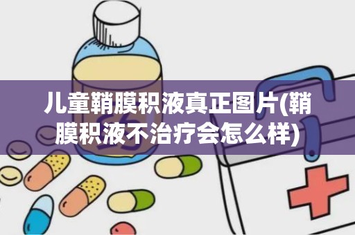 儿童鞘膜积液真正图片(鞘膜积液不治疗会怎么样)